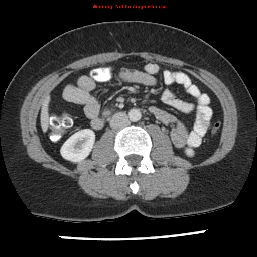 File:Acute appendicitis (Radiopaedia 7966-8812 C+ portal venous phase 21).jpg