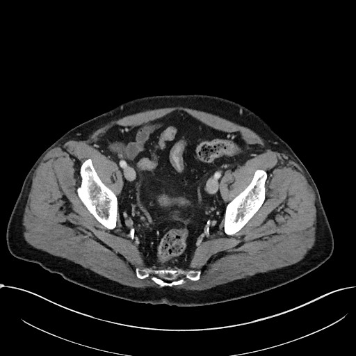 Acute appendicitis - large appendicoliths (Radiopaedia 61805-69820 Axial C+ portal venous phase 111).jpg