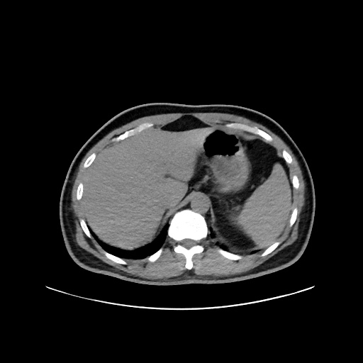 Acute appendicitis and COVID 19 pneumonia (Radiopaedia 76604-88380 Axial non-contrast 53).jpg