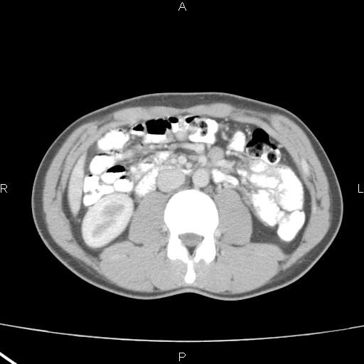 File:Acute appendicitis with CT arrowhead sign (Radiopaedia 21474-21411 Axial C+ portal venous phase 18).jpg