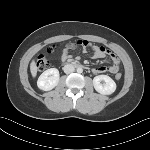 File:Acute appendicitis with appendicoliths (Radiopaedia 50186-55532 Axial C+ portal venous phase 37).png