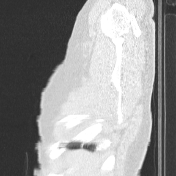 Acute aspiration pneumonitis (Radiopaedia 33605-34703 Sagittal lung window 8).jpg