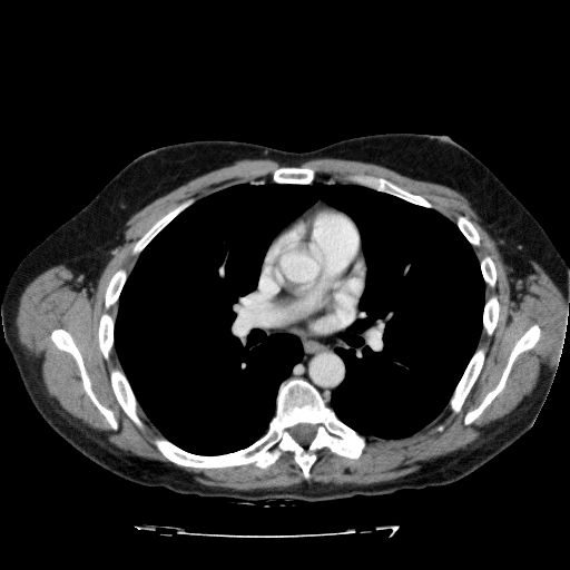 File:Acute cholecystitis and incidental left sided IVC (Radiopaedia 49352-54459 Axial C+ portal venous phase 2).jpg