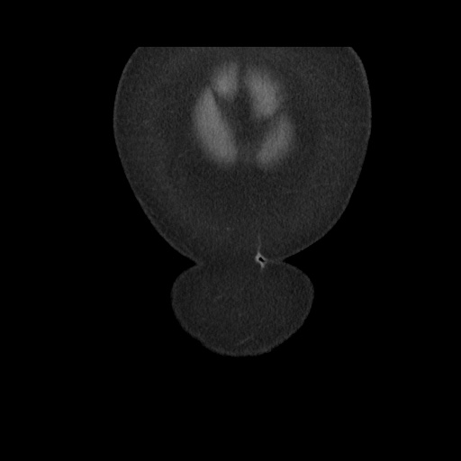 File:Acute cholecystitis with tensile fundus sign (Radiopaedia 71394-81723 Coronal non-contrast 16).jpg