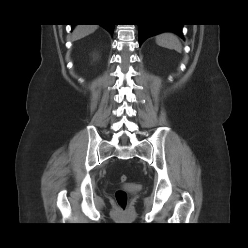 Acute cholecystitis with tensile fundus sign (Radiopaedia 71394-81723 Coronal non-contrast 90).jpg