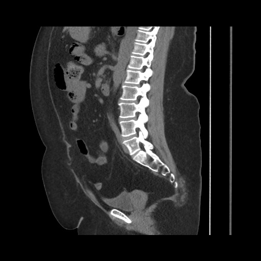 File:Acute cholecystitis with tensile fundus sign (Radiopaedia 71394-81723 Sagittal non-contrast 95).jpg