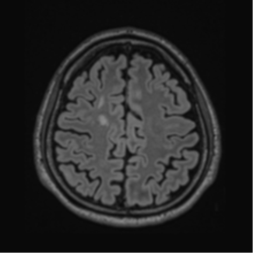 Acute disseminated encephalomyelitis (ADEM)- Anti-NMDA receptor encephalitis (Radiopaedia 54920-61201 Axial FLAIR 52).png