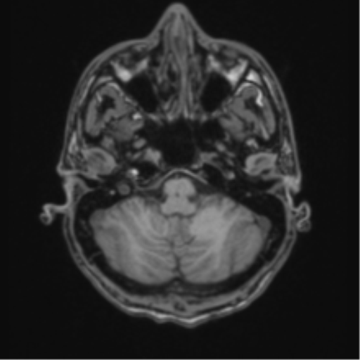 Acute disseminated encephalomyelitis (ADEM) (Radiopaedia 65319-74349 Axial T1 9).png