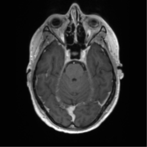 Acute disseminated encephalomyelitis (ADEM) (Radiopaedia 65319-74350 Axial T1 C+ 16).png