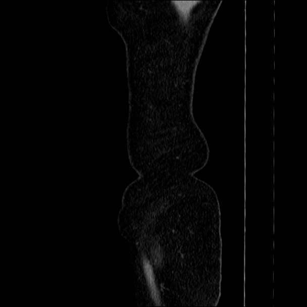 Acute diverticulitis (Radiopaedia 34183-35442 Sagittal C+ portal venous phase 2).jpg