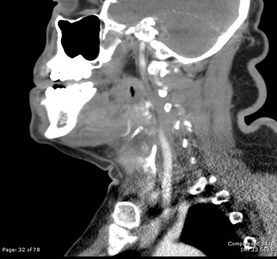 Acute epiglottitis (Radiopaedia 54375-60590 Sagittal C+ arterial phase 32).jpg