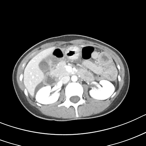 Acute gangrenous appendicitis with perforation (Radiopaedia 40152-42662 Axial C+ portal venous phase 25).png