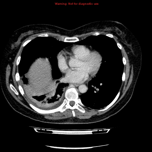 Acute gangrenous cholecystitis (Radiopaedia 10123-10661 Axial C+ portal venous phase 3).jpg