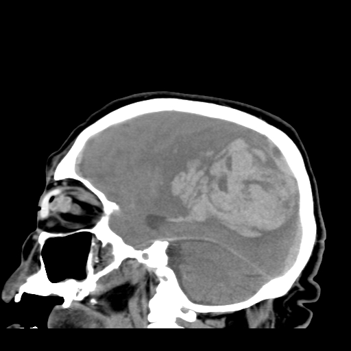File:Acute hemorrhagic stroke (Radiopaedia 17507-17223 Sagittal non-contrast 15).jpg