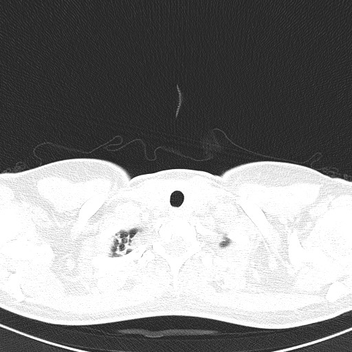 File:Acute hypersensitivity pneumonitis (Radiopaedia 85293-100870 Axial lung window 1).jpg