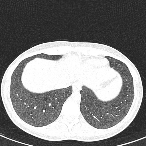File:Acute hypersensitivity pneumonitis (Radiopaedia 85293-100870 Axial lung window 99).jpg