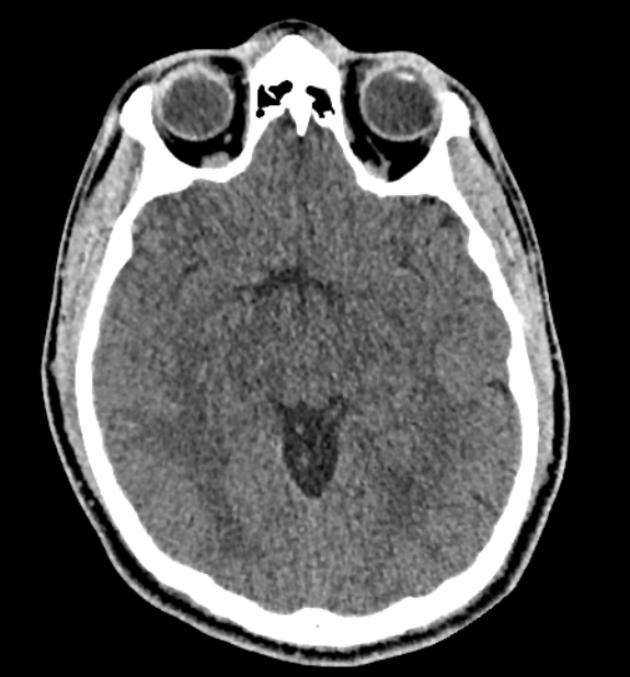 Acute ischemic stroke - posterior circulation territory (Radiopaedia 77670-89881 non-contrast 39).jpg