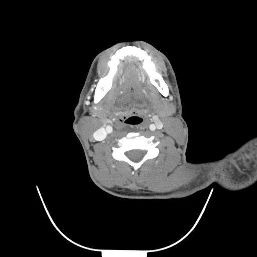 Acute longus colli calcific tendinitis (Radiopaedia 72495-83036 Axial C+ arterial phase 45).jpg