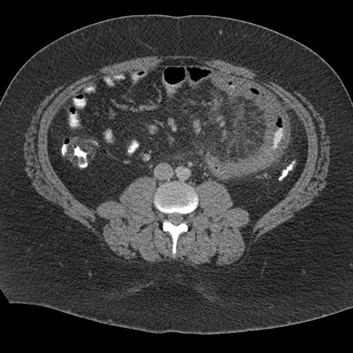 Acute mesenteric venous ischemia (Radiopaedia 46041-50383 Axial C+ portal venous phase 70).jpg
