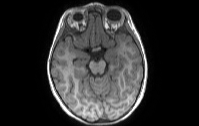 Acute necrotizing encephalitis of childhood (Radiopaedia 67356-76737 Axial T1 61).jpg