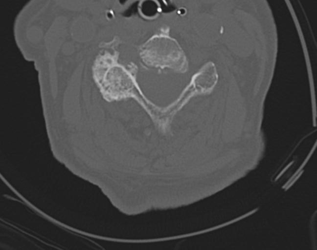 Acute on chronic subdural hematoma and thoracic vertebral injury in a multitrauma patient (Radiopaedia 31698-32619 Axial bone window 32).jpg