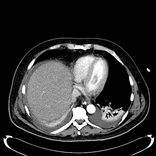 File:Acute pancreatic necrosis (Radiopaedia 13560-18500 Axial C+ portal venous phase 19).jpg