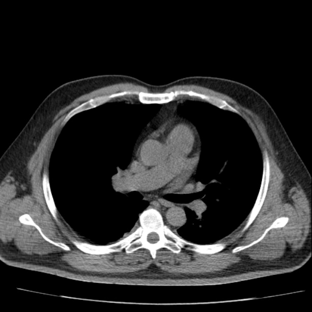 Acute pancreatitis (Radiopaedia 26663-26813 Axial non-contrast 1).jpg