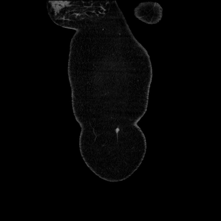 Acute pancreatitis (Radiopaedia 69236-79012 Coronal C+ portal venous phase 69).jpg