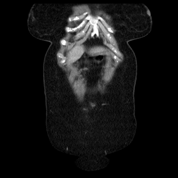 Acute pancreatitis - Balthazar C (Radiopaedia 26569-26714 Coronal C+ portal venous phase 13).jpg