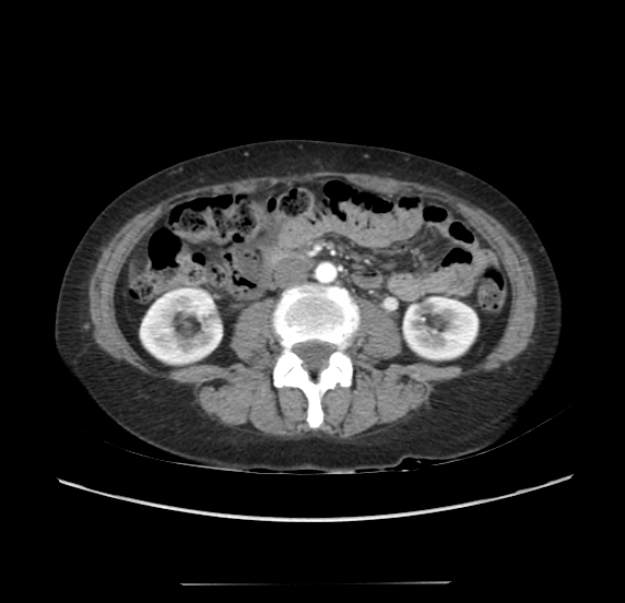 File:Acute pancreatitis - Balthazar E - post ERCP (Radiopaedia 27562-27772 Axial C+ arterial phase 32).png