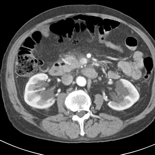 File:Acute pancreatitis and walled-off necrosis (Radiopaedia 29888-30403 Axial C+ portal venous phase 24).jpg