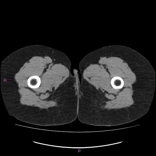 Acute pancreatitis secondary to stone at minor papilla and pancreatic divisum (Radiopaedia 76570-88333 Axial non-contrast 92).jpg