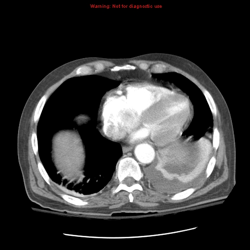 Acute pancreatitis with incidental pancreatic lipoma (Radiopaedia 10190-10730 Axial C+ arterial phase 9).jpg