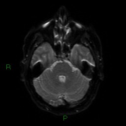 File:Acute posterior cerebral artery territory infarct (Radiopaedia 79329-92394 Axial DWI 37).jpg