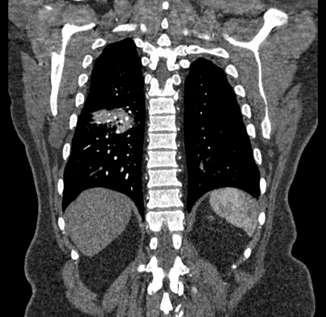 Acute pulmonary embolism with pulmonary infarcts (Radiopaedia 77688-89908 Coronal C+ CTPA 83).jpg