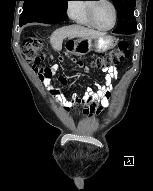 Acute renal infarction - rim capsular enhancement (Radiopaedia 59833-67270 Coronal C+ portal venous phase 1).jpg