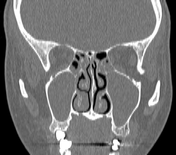 Acute sinusitis (Radiopaedia 40564-43158 Coronal bone window 23).jpg