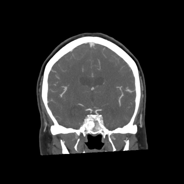 Acute subarachnoid hemorrhage and accessory anterior cerebral artery (Radiopaedia 69231-79009 Coronal C+ arterial phase 42).jpg