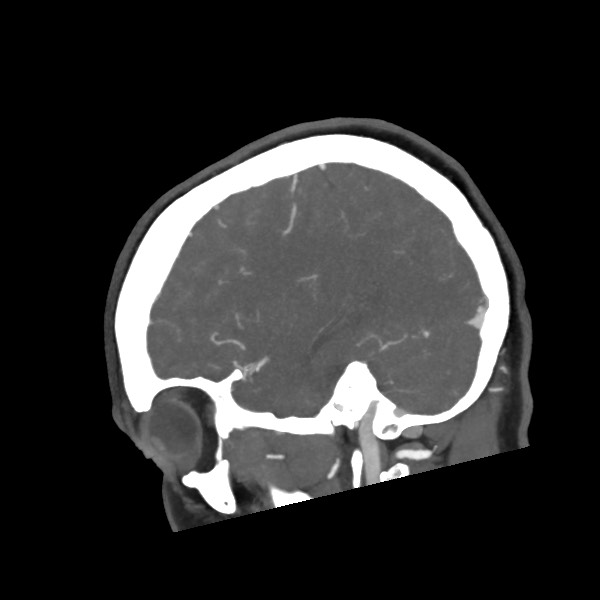 Acute subarachnoid hemorrhage and accessory anterior cerebral artery (Radiopaedia 69231-79009 Sagittal C+ arterial phase 22).jpg