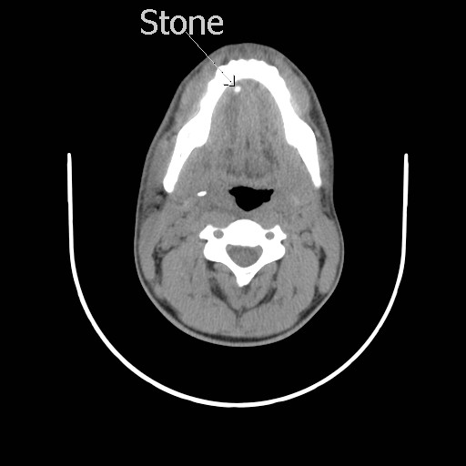 File:Acute submandibular sialadenitis secondary to ductal stone (Radiopaedia 27999-28267 Axial non-contrast 3).jpg