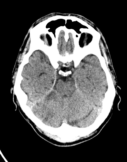 Acute superior cerebellar artery territory infarct (Radiopaedia 84104-99359 Axial non-contrast 46).jpg