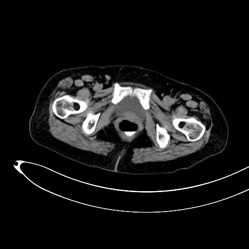 Adenocarcinoma colon with intussusception (Radiopaedia 86006-101922 Axial non-contrast 64).jpg