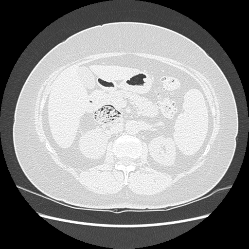 Adenocarcinoma in situ of lung (Radiopaedia 38685-40829 B 246).png