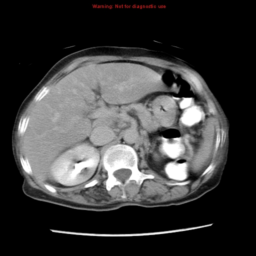 File:Adenocarcinoma of the colon (Radiopaedia 8191-9039 Axial renal excretory phase 10).jpg