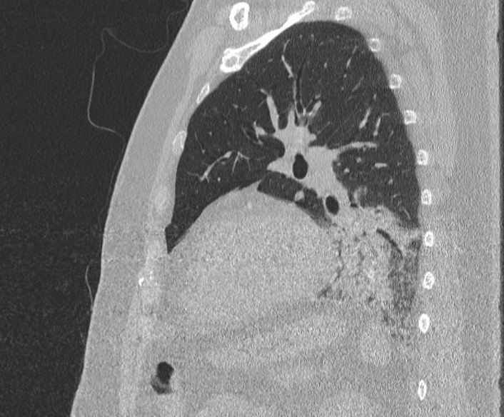 Adenoid cystic carcinoma of the trachea (Radiopaedia 49042-54137 Sagittal lung window 320).jpg