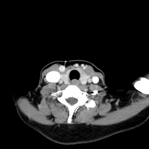 File:Adenoid cystic tumor of palate (Radiopaedia 46980-51518 Axial C+ delayed 57).png