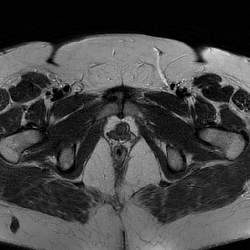 File:Adenomyosis within a didelphys uterus (Radiopaedia 70175-80215 Axial T2 32).jpg