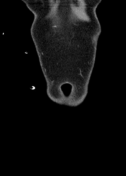 Adhesional small bowel obstruction (Radiopaedia 48397-53305 Coronal C+ portal venous phase 17).jpg