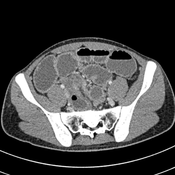 File:Adhesional small bowel obstruction (Radiopaedia 52107-57980 Axial C+ portal venous phase 97).jpg