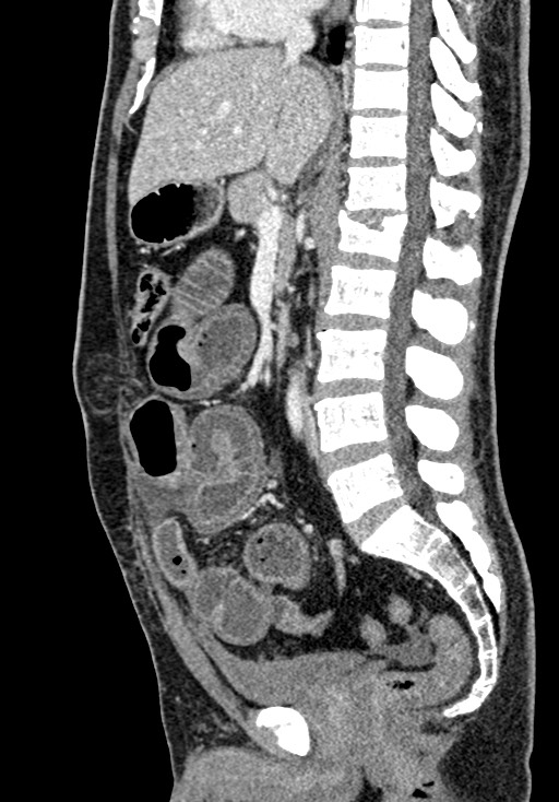 Adhesional small bowel obstruction (Radiopaedia 58900-66131 Sagittal C+ portal venous phase 123).jpg